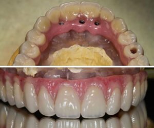 Implant-solution-metal-ceramic-bridge-over-implants