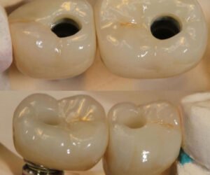Implant-solution-metal-ceramic-implant-crowns