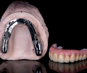 bar-over-denture
