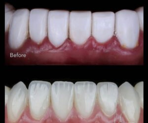 metal-free-emax-veneers