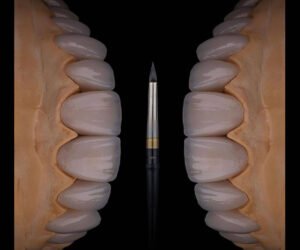 metal-free-emax-veneers-layered