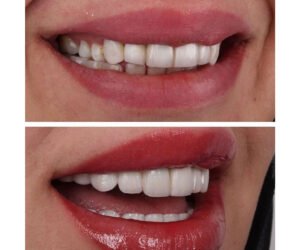 metal-free-zirconium-crowns