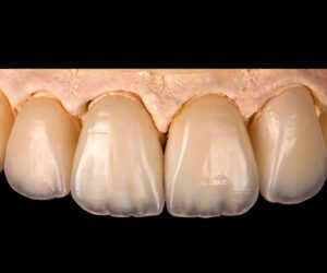 metal-free-zirconium-with-layered