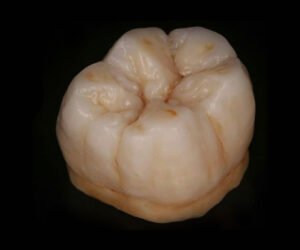 metal-free-zolid-HT-full-momolithic-crowns-and-bridges